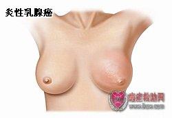 乳腺癌的临床表现 炎性乳腺癌 炎性乳腺癌-病因，炎性乳腺癌-临床表现