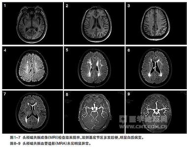 流行病学病因 脑内转移瘤 脑内转移瘤-流行病学，脑内转移瘤-病因