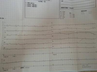 心电图t波低平 心电图异常 心电图异常-介绍，心电图异常-t波低平