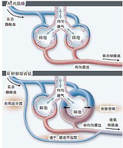 唐氏综合征发病率 肝肺综合征 肝肺综合征-病因及发病率，肝肺综合征-发病机理