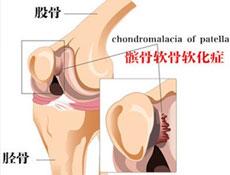 髌骨软化症mri表现 髌骨软化症 髌骨软化症-病因，髌骨软化症-临床表现