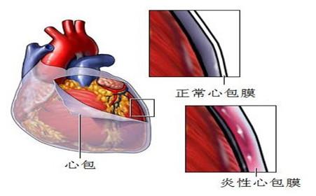 缩窄性心包炎病因 急性心包炎 急性心包炎-简介，急性心包炎-病因