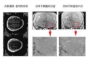 急性前列腺炎病因病理 高血压脑病 高血压脑病-疾病概述，高血压脑病-病因病理