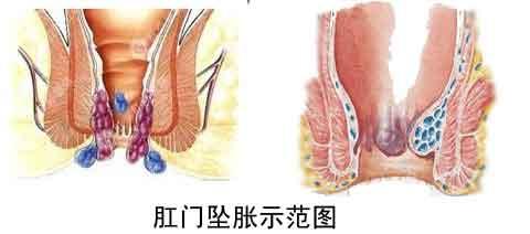 肛门坠胀是什么原因 肛门坠胀 肛门坠胀-肛门坠胀，肛门坠胀-肛门坠胀原因