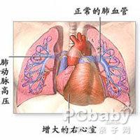 动脉导管未闭 动脉导管未闭 动脉导管未闭-发病原因，动脉导管未闭-疾病概述