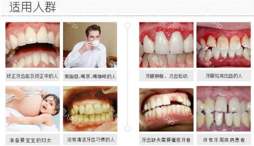 超声波洁牙原理 超声波洁牙 超声波洁牙-原理，超声波洁牙-特点