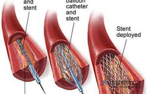 心脏支架发展历史 心脏支架 心脏支架-简单介绍，心脏支架-研制历史