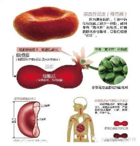 蚕豆病病因 蚕豆病 蚕豆病-病因，蚕豆病-临床表现