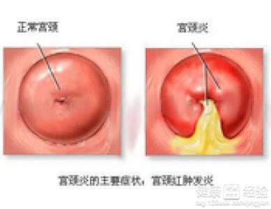 宫颈炎的发病原因 宫颈炎 宫颈炎-名词解释，宫颈炎-发病原因