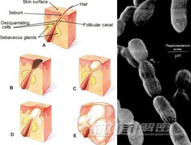 痤疮丙酸杆菌 痤疮丙酸杆菌 痤疮丙酸杆菌-临床表现