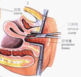 盆腔脓肿 盆腔脓肿有什么危害