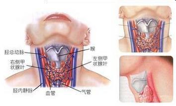 桥本氏甲状腺炎病因 桥本甲状腺炎 桥本甲状腺炎-类型，桥本甲状腺炎-病因病理