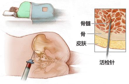 骨髓穿刺部位 骨髓穿刺 骨髓穿刺-骨髓穿刺部位，骨髓穿刺-适应证