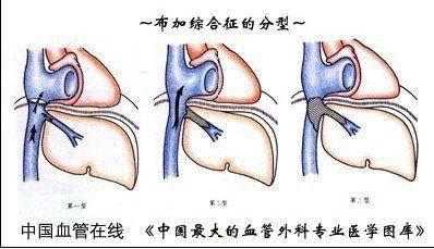 布加氏综合征 布加氏综合征 布加氏综合征-概述，布加氏综合征-主要分型