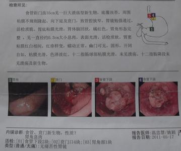 胃印戒细胞癌早期症状 胃印戒细胞癌 胃印戒细胞癌-概述，胃印戒细胞癌-症状