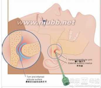 颞下颌关节炎 颞下颌关节炎 颞下颌关节炎-介绍，颞下颌关节炎-致病原因