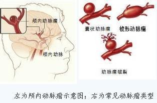 临床常见疾病概述 颅内动脉瘤 颅内动脉瘤-疾病概述，颅内动脉瘤-临床表现