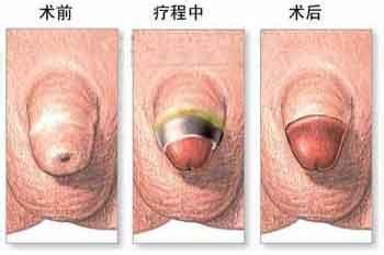 肠粘连最快解决方法 包皮粘连 包皮粘连-基本内容，包皮粘连-解决方法