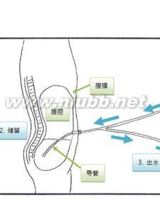 腹膜透析 腹膜透析 腹膜透析-概述，腹膜透析-（一）方法