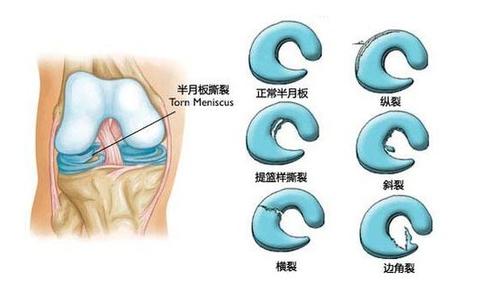 半月板撕裂必须手术吗 半月板撕裂怎么办