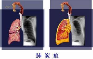 炭疽病 炭疽 炭疽-病原简介，炭疽-内容概述