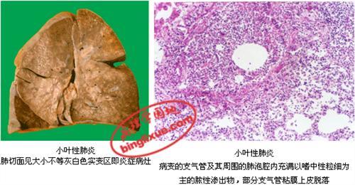 老年精神疾病病因 大叶性肺炎 大叶性肺炎-疾病简介，大叶性肺炎-病因