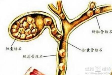 胆结石最佳治疗方法 胆结石饮食禁忌