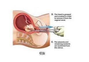 刮宫后几天复查 刮宫 刮宫-简介，刮宫-刮宫复查