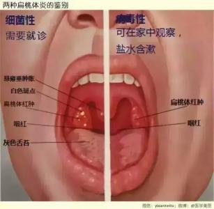 疱疹性咽炎 疱疹性咽炎 疱疹性咽炎-特点，疱疹性咽炎-检查