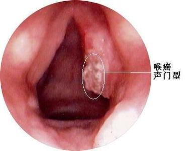 食管癌早期症状 喉癌早期的症状有哪些