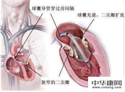 二尖瓣狭窄的症状 二尖瓣狭窄 二尖瓣狭窄-疾病概述，二尖瓣狭窄-疾病症状