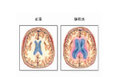 高原脑水肿 高原脑水肿 高原脑水肿-流行病学，高原脑水肿-病因