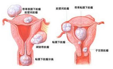 不孕病症 子宫性不孕 子宫性不孕-定义，子宫性不孕-病症类型