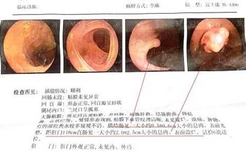 直肠癌的早期症状 直肠类癌 直肠类癌-【什么是直肠类癌】，直肠类癌-【如何诊治直