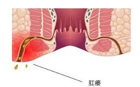 高位肛瘘病因 高位肛瘘 高位肛瘘-病因，高位肛瘘-症状