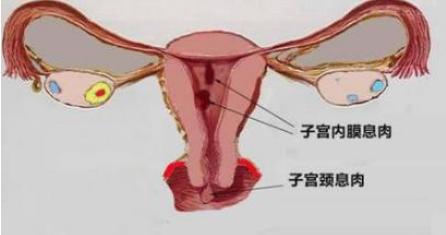 子宫颈息肉 子宫颈息肉 子宫颈息肉-简介，子宫颈息肉-病因