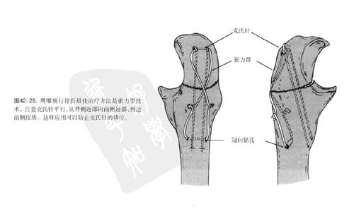 尺骨鹰嘴骨折 尺骨鹰嘴骨折 尺骨鹰嘴骨折-简介，尺骨鹰嘴骨折-发病机理