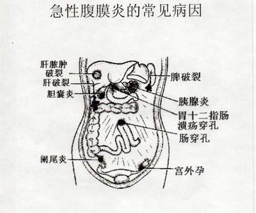 腹泻病理生理分类 急性腹膜炎 急性腹膜炎-分类，急性腹膜炎-病理生理