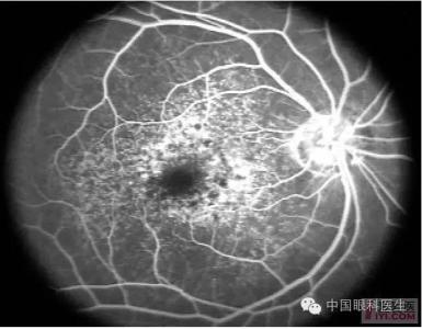 前列腺炎典型病例 眼底病 眼底病-简介，眼底病-典型病例