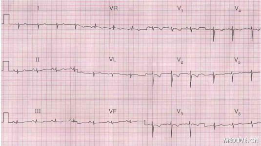 心电图记录纸 心电图 心电图-心电图，心电图-心电图记录方法