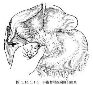 肝破裂的临床表现 肝破裂 肝破裂-临床表现，肝破裂-基本内容