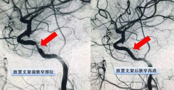 脑血管狭窄怎么治疗 脑血管狭窄 脑血管狭窄-脑血管狭窄的简介，脑血管狭窄-脑血管狭