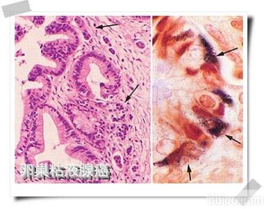 粘液腺癌 粘液腺癌 粘液腺癌-简介，粘液腺癌-增生、囊肿