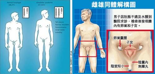 特纳氏综合症 特纳氏综合症 特纳氏综合症-病理简介，特纳氏综合症-症状和体征