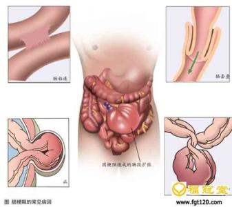 带状疱疹的症状体征 腹外疝 腹外疝-病因，腹外疝-症状体征