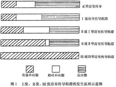 房室传导阻滞病因 房室传导阻滞 房室传导阻滞-病理病因，房室传导阻滞-主要分类