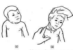 先天性肌性斜颈的病因 斜颈 斜颈-病因，斜颈-症状