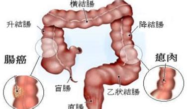 大肠癌的病因 大肠癌 大肠癌-简介，大肠癌-主要病因