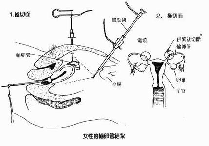 无储精囊避孕套的优点 自然避孕法 自然避孕法-优点，自然避孕法-原理