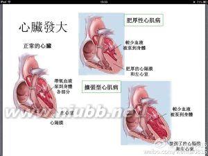 扩张型心肌病病因 心肌病 心肌病-概述，心肌病-病因